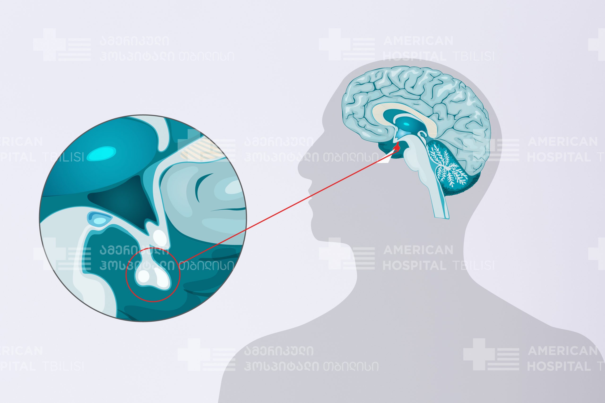 AHT Pituitary Gland and Pituitary Tumors American Hospital Tbilisi