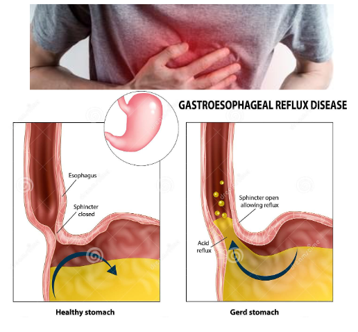Gastroesofageal refluxsjukdom